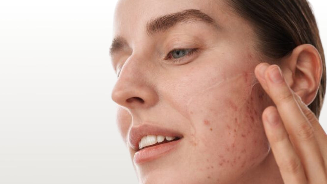 The Role of Inflammation & How to Manage Sensitivity and Acne